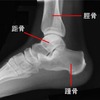 図1：足関節のレントゲン